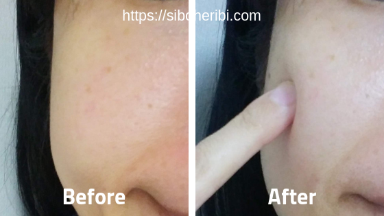 FCEセラムビフォアーアフター