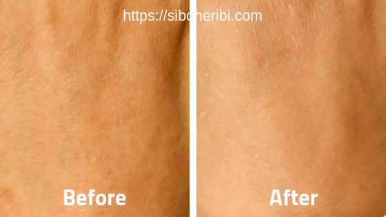 キスハダビフォアアフター