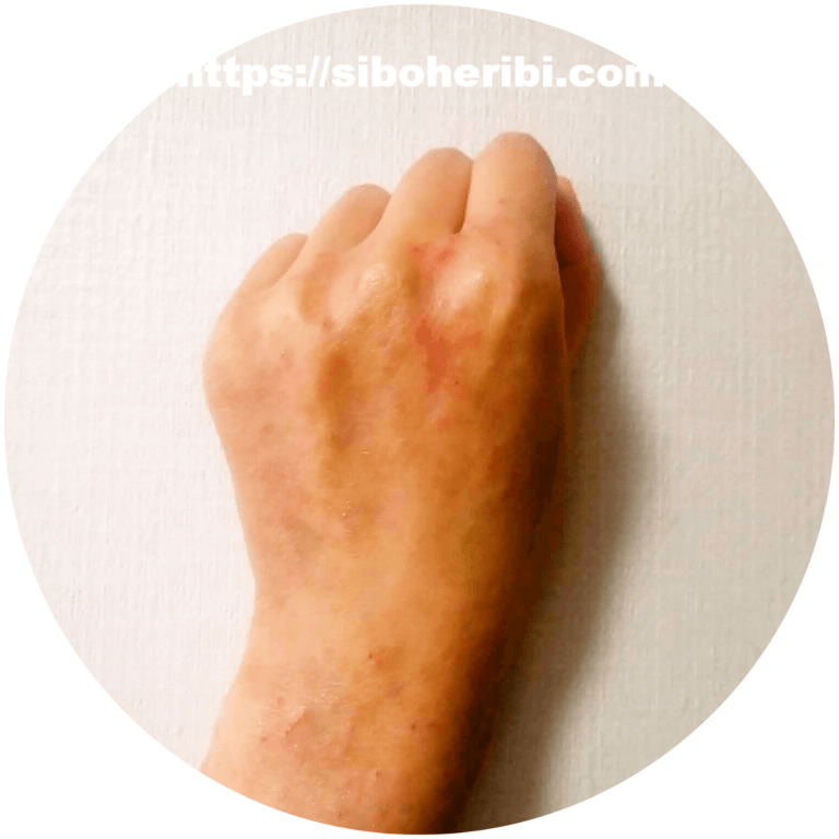 アトピスマイルを使って２週間後のアトピー写真