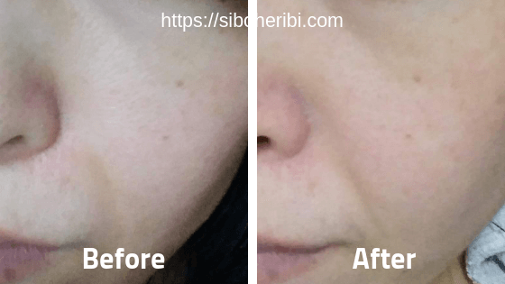 ＢＭアルファＶローションＤＸ：ビフォアアフター